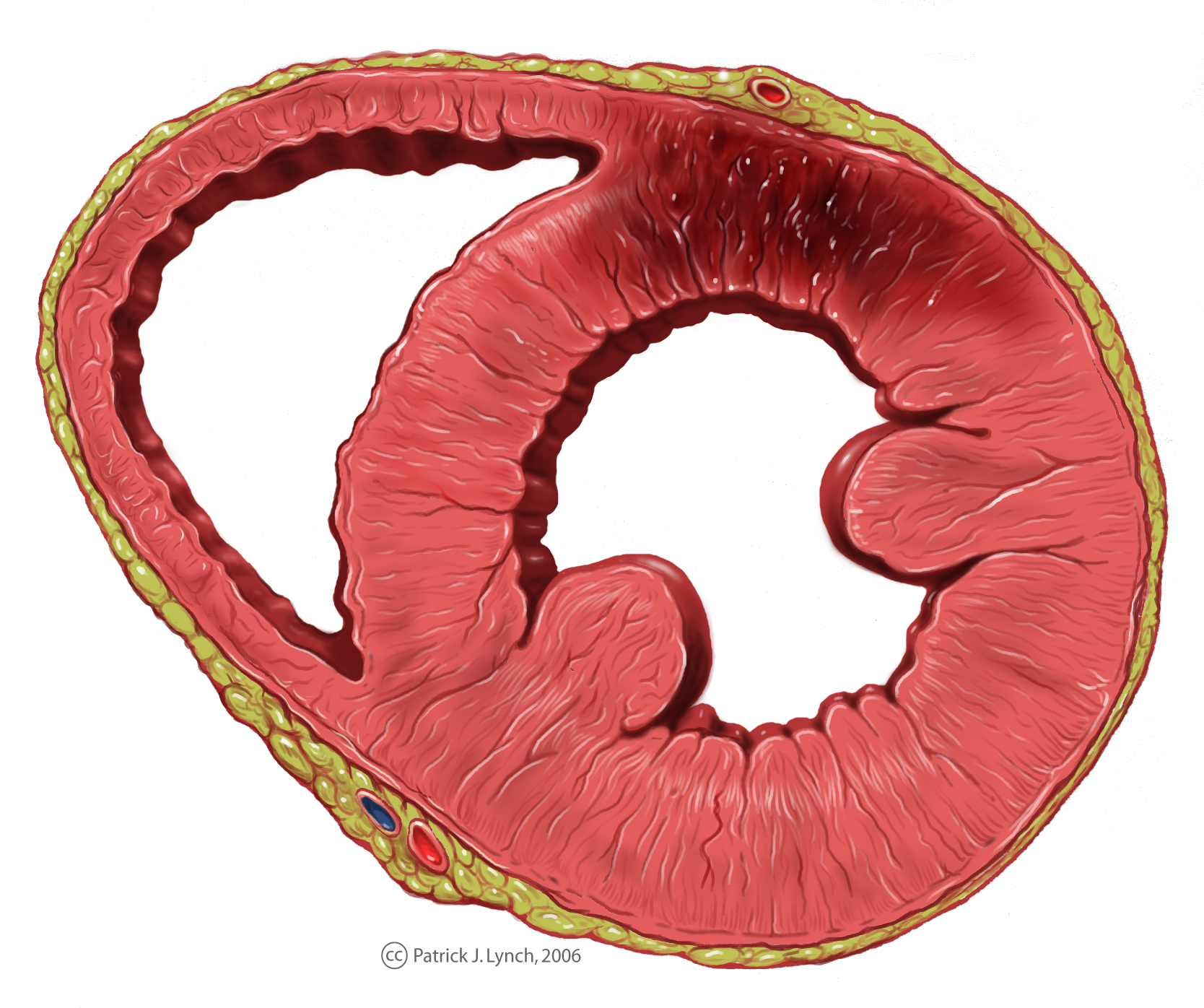 Regional ischemia in a myocardial infarction