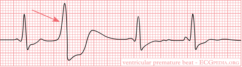 Bestand:Rhythm ventricular premature.png