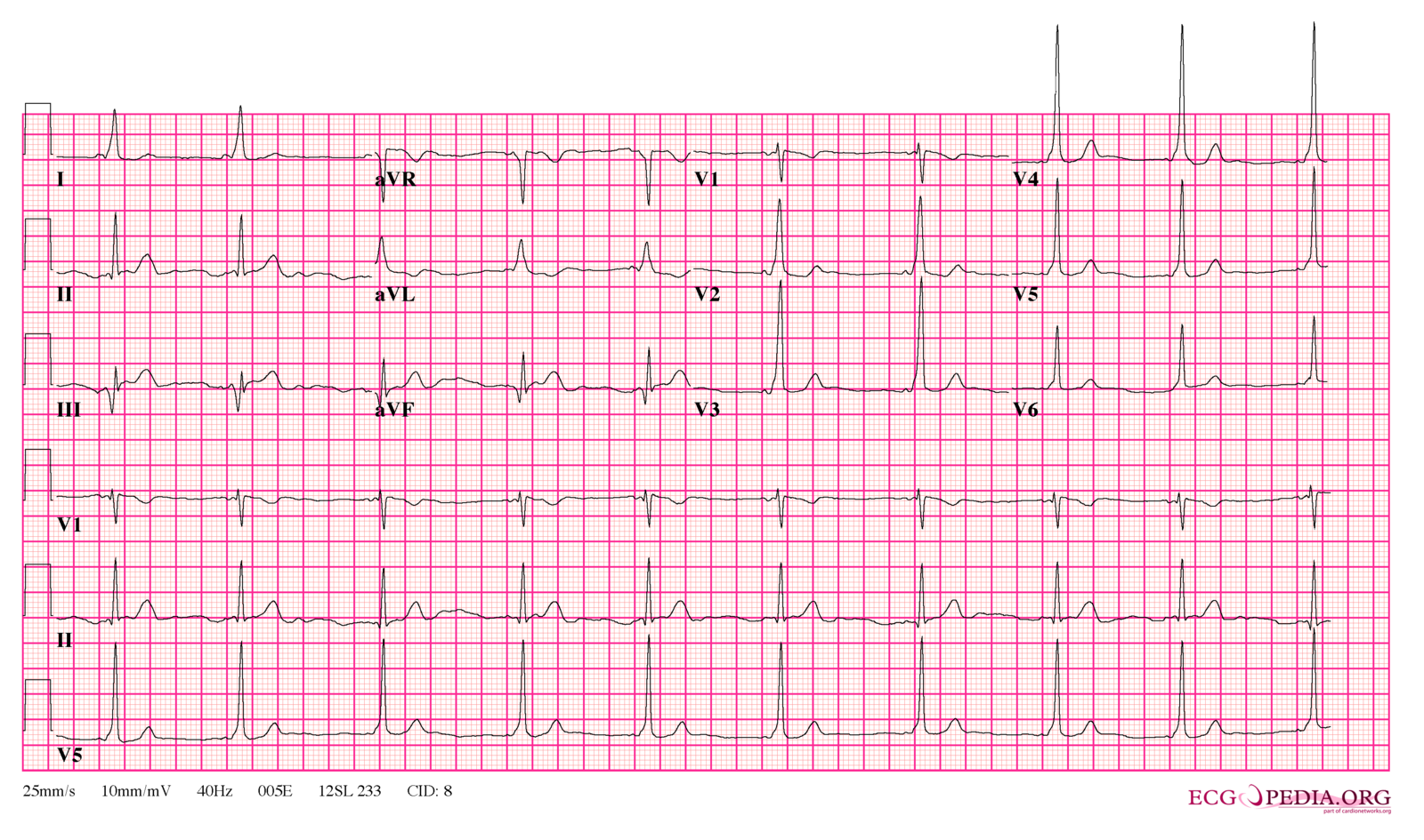 File Wpw Full Ecg3 Png ECGpedia