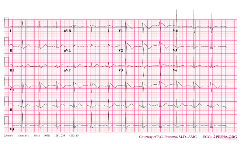 Bestand:Brugada syndrome type1 example4.png