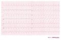 Ventrikeltachycardie van 145/min. met een rechterbundeltakblok-configuratie en linkerhartas.