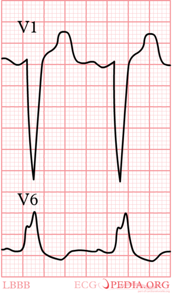 Bestand:LBBB.png