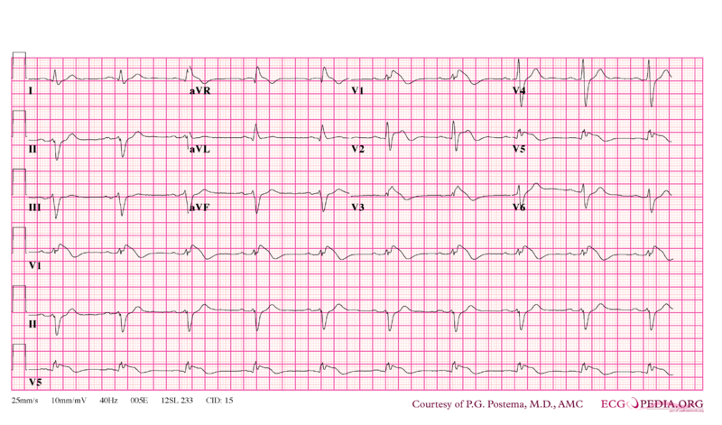 Bestand:Brugada syndrome type1 example2.png