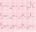 Een voorbeeld van een acuut voorwandinfarct. ST elevatie in I, AVL en V2-V5. Reciproke depressies in de onderwandsafleidingen (II,III,AVF)
