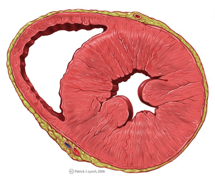 Bestand:Heart left ventricular hypertrophy sa.jpg