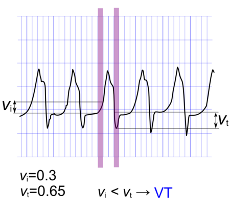 Breed Complextachycardi N Ecgpedia