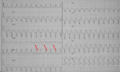 AV-dissociatie tijdens ventrikeltachycardie, de pijlen wijzen de P-toppen aan