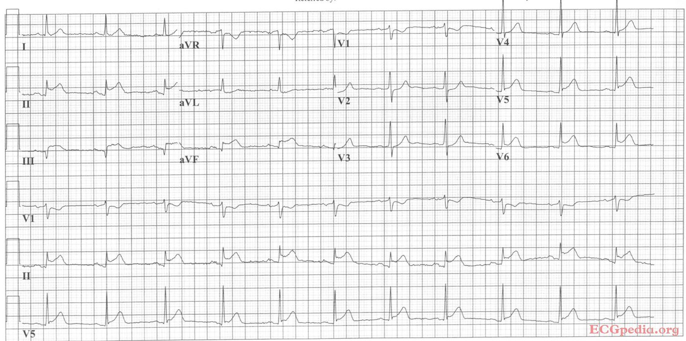 Mi Ecgpedia