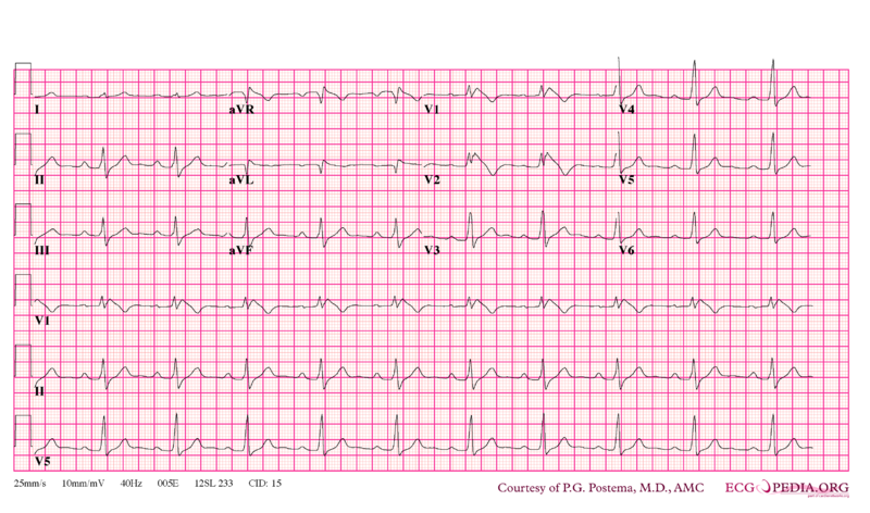 Bestand:Brugada syndrome type1 example3.png