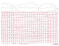 Ventrikeltachycardie van 150/min. met een rechterbundeltakblokconfiguratie en rechterhartas. Let op het 5e en 6e complex van rechts. Dit zijn fusiecomplexen.