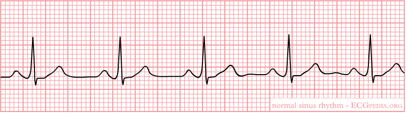 Normaal sinusritme