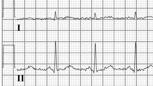 Bestand:Electric noise ecg.png
