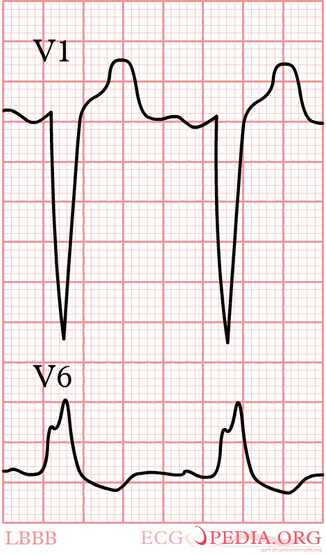 LBBB.png