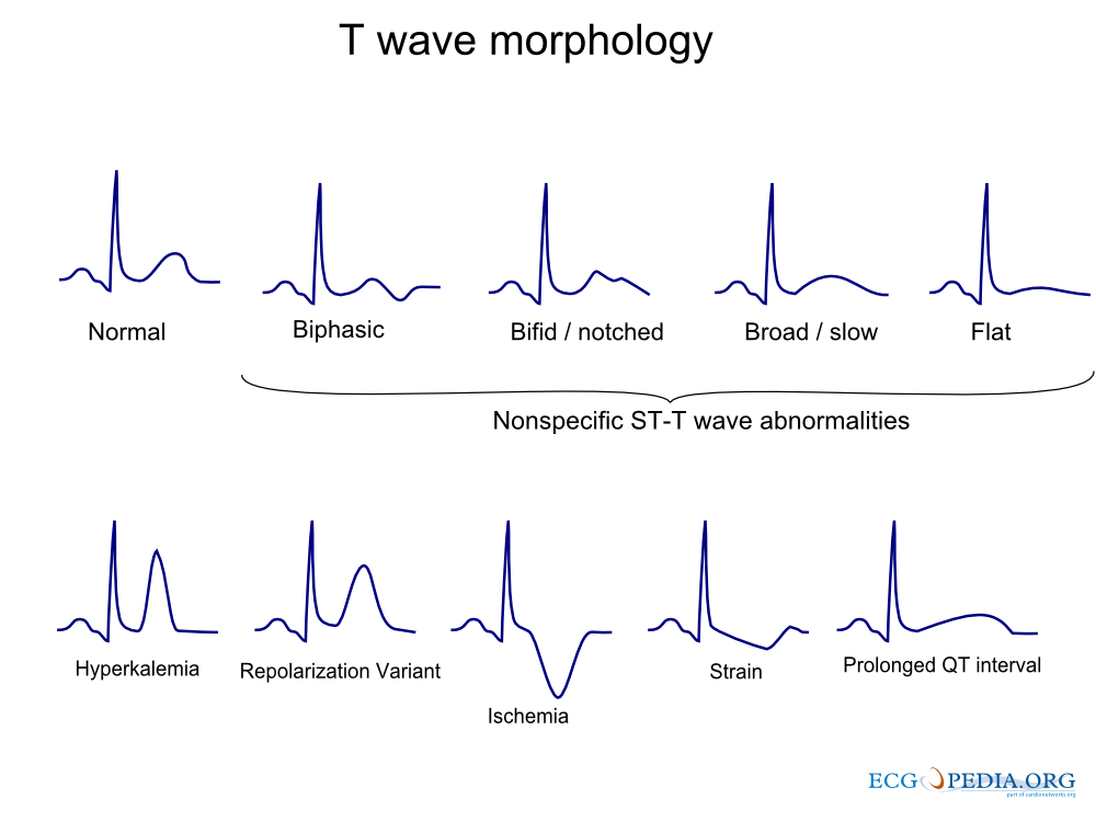 File T Wave Morphology png ECGpedia