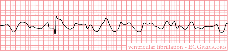 Bestand:Rhythm ventricular fibrillation.png