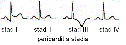 Bestand:Pericarditis stadia.GIF
