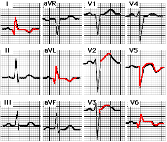 Bestand:Anterolateral infarct ecg.GIF