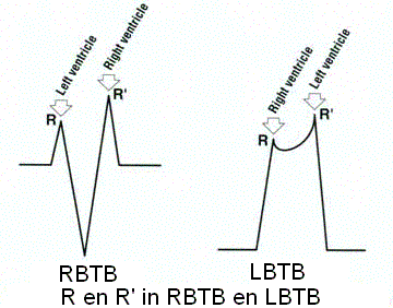 Verschil RR' LBTB en RBTB.GIF