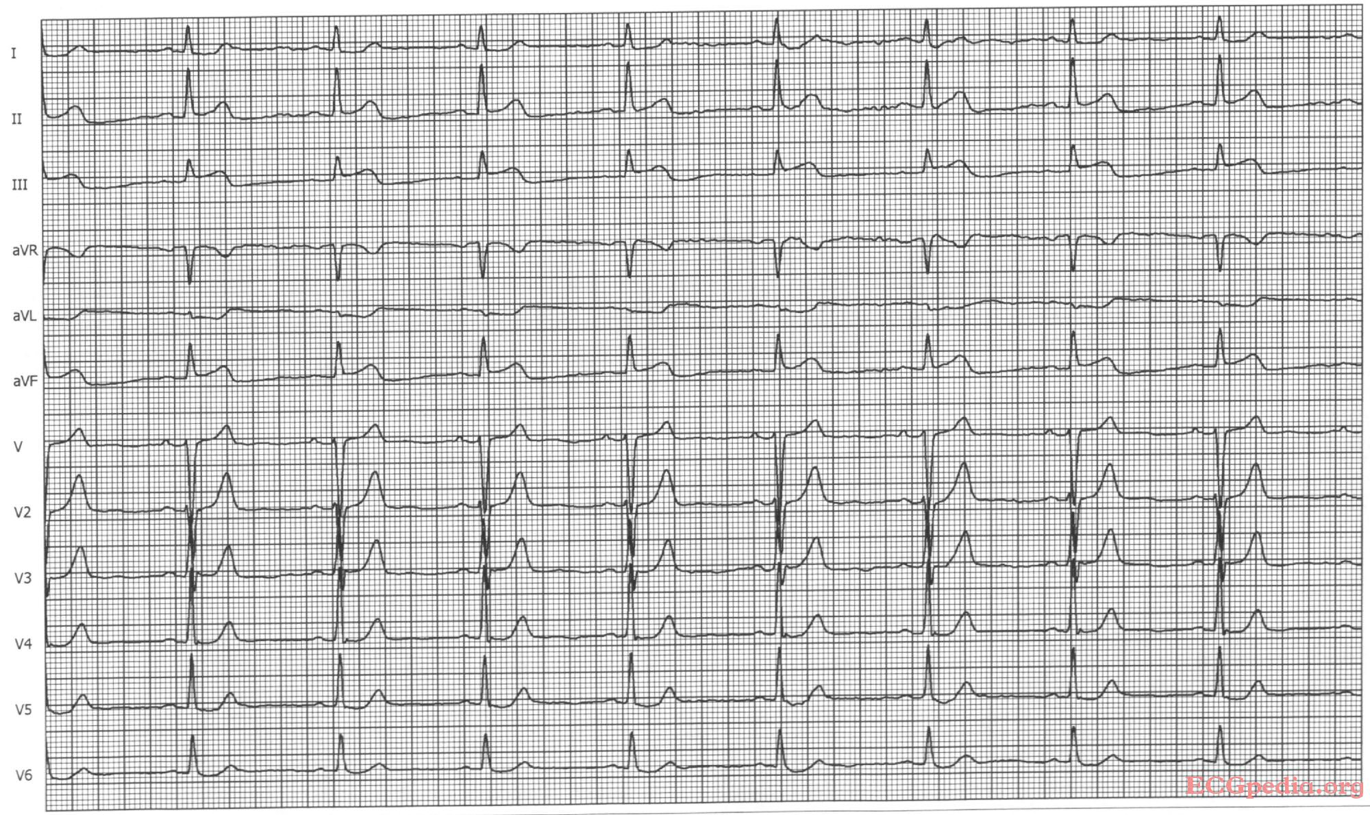 Myocardial infarction ECG. ЭКГ при рассеянном склерозе. ЕКГ аппаратлари. EKG 6000.