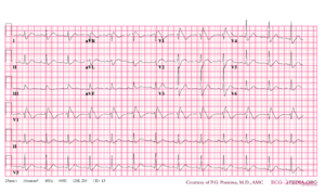Brugada syndrome type1 example5.png