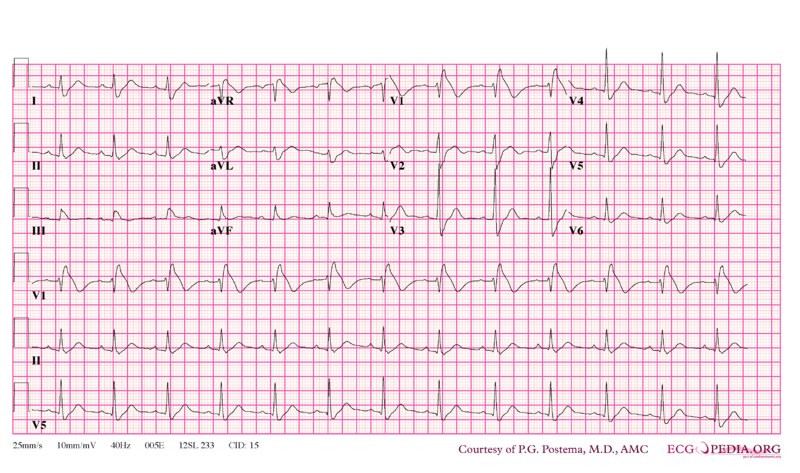 Bestand:Brugada syndrome type1 example5.png