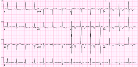 Clinical Disorders - ECGpedia