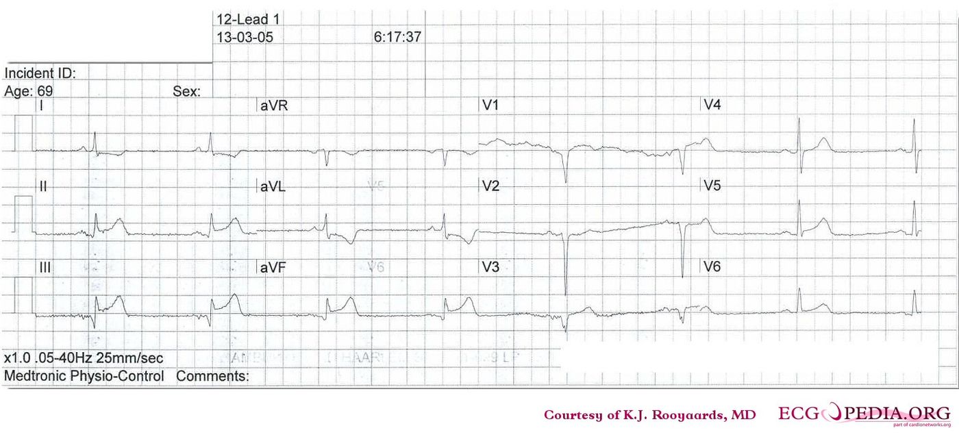 MI 23 - ECGpedia