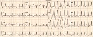 Wide qrs tachy AAM1.jpg
