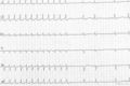 AV Nodal Re-entry Tachycardia (AVNRT) terminated by adenosine injection. Note that the last complex of the tachycardia has a retrograde P wave. Termination by block in the slow pathway is typical for common type AVNRT