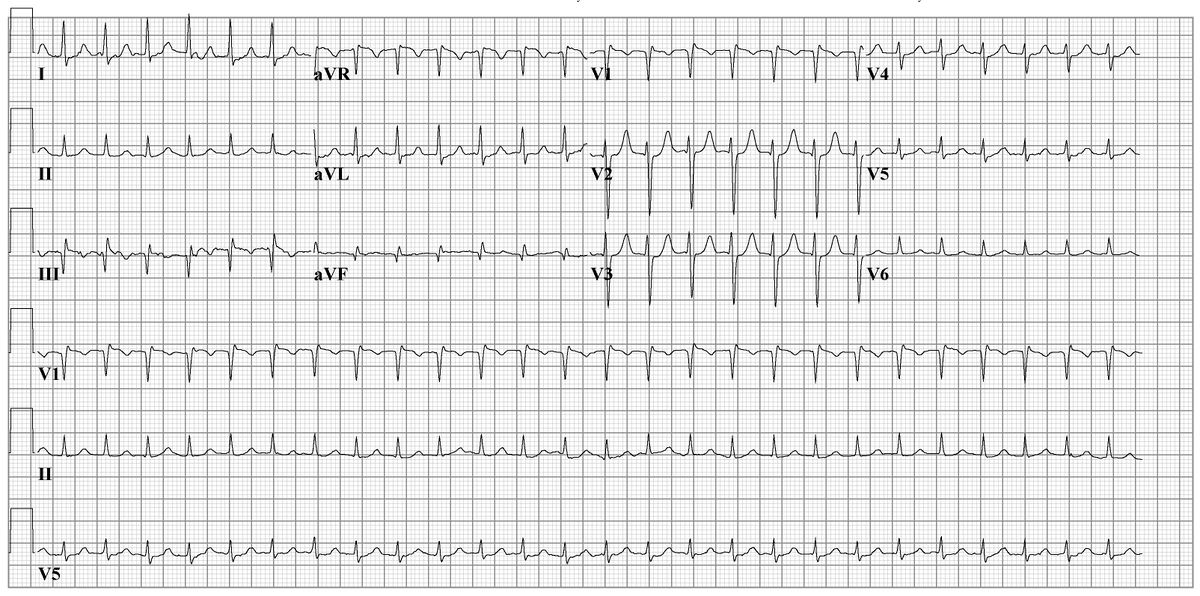 File:Avnrt ecg2.jpg - ECGpedia