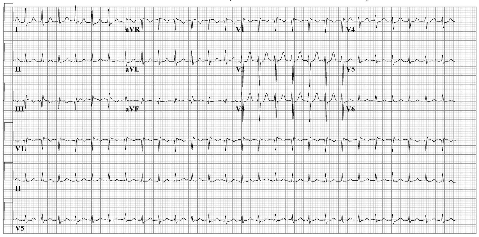 File:avnrt Ecg2.jpg - Ecgpedia