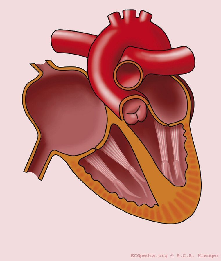 What Is Right Atrial Enlargement