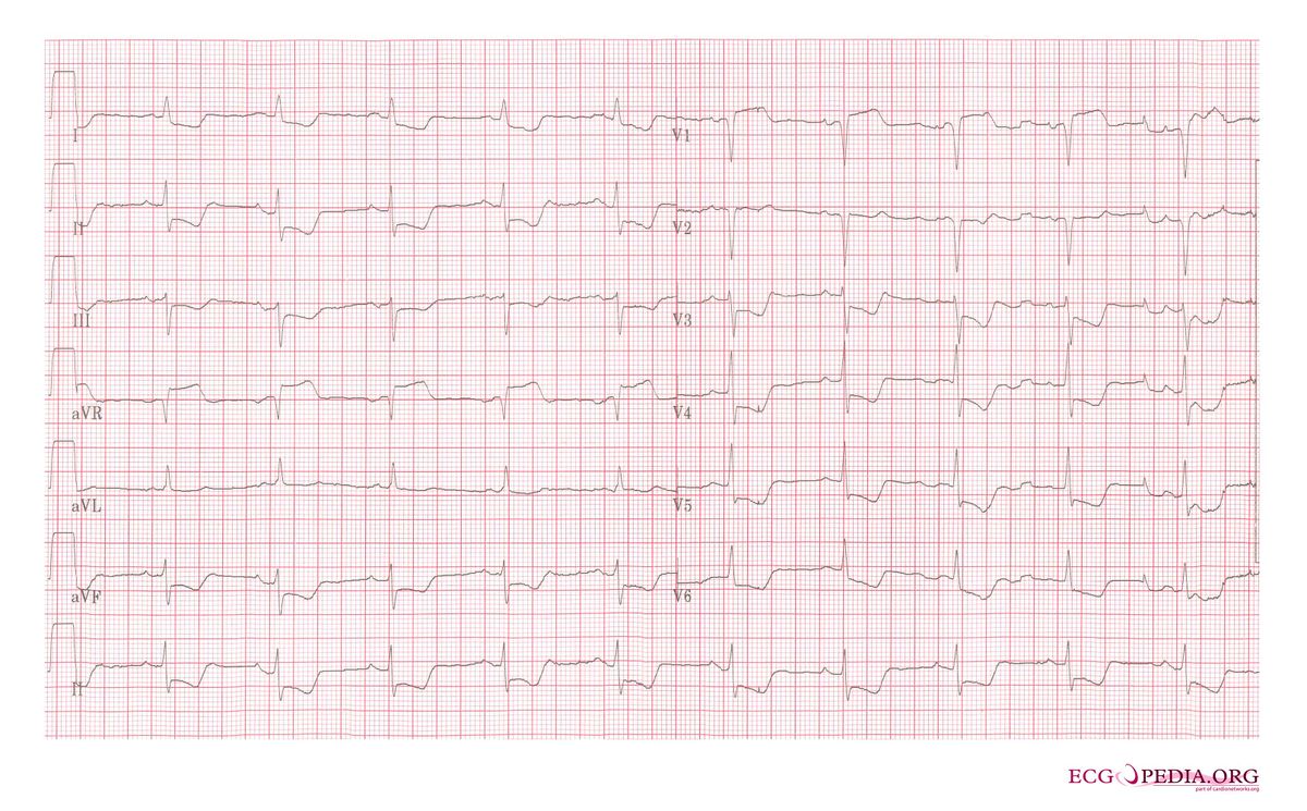 File:Subendocardial ischemia.jpg - ECGpedia