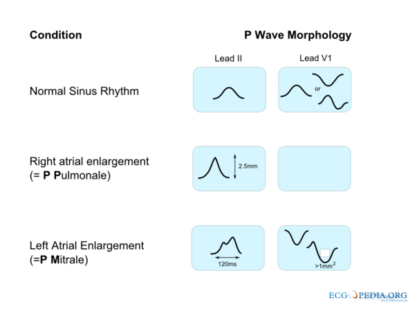 left-atrium-enlargement-ekg-features-youtube