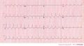 Another example of an ECG of a patiënt with pulmonary embolism. Note the tachycardia and right axis.