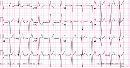 Pacemaker - ECGpedia