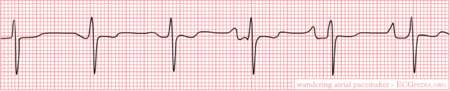 Wandering Pacemaker - ECGpedia