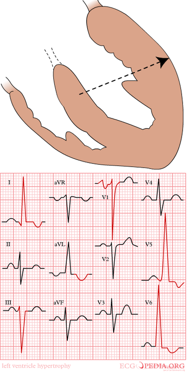 Chamber Hypertrophy And Enlargment ECGpedia