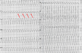 AV-dissociatie tijdens ventrikeltachycardie, de pijlen wijzen de P-toppen aan