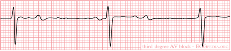 AV Conduction - ECGpedia