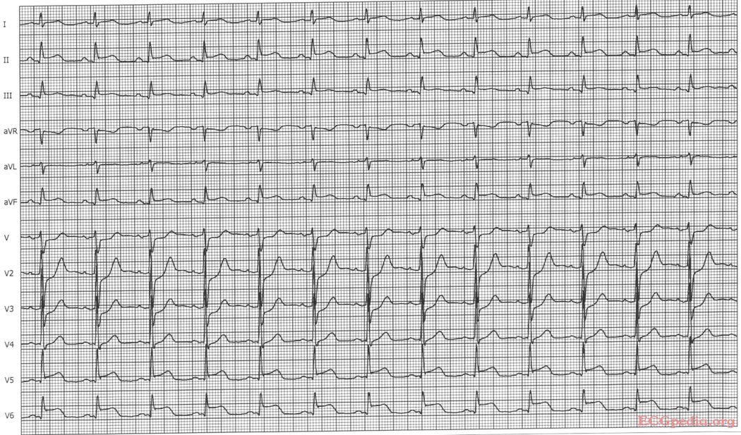 Answer Mi 10 - Ecgpedia