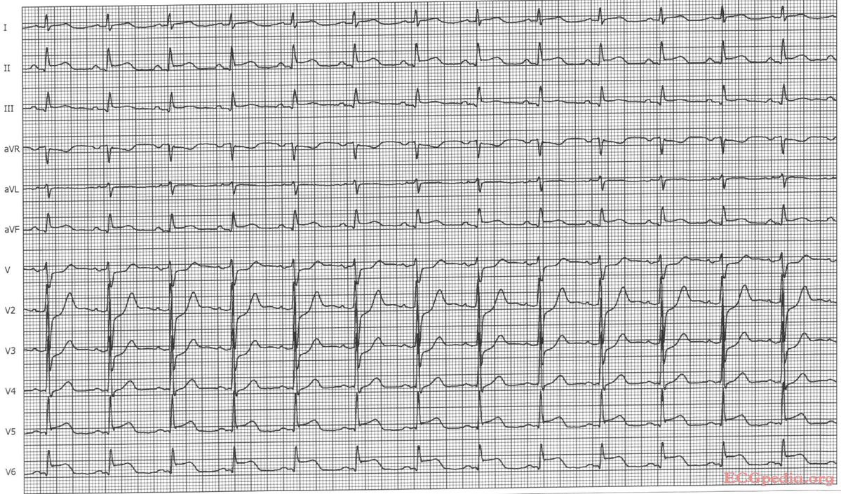 File:Ami0010.jpg - ECGpedia