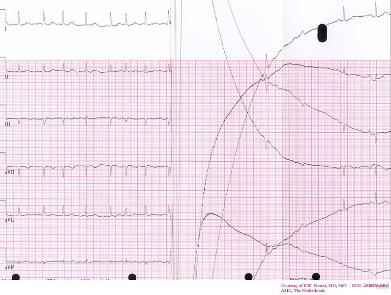 Bestand:Cardioversion from afib.jpg