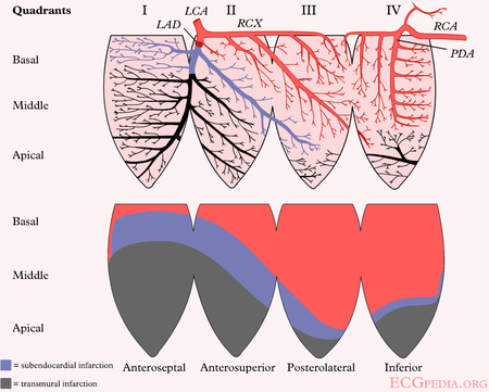 Anterior MI - ECGpedia