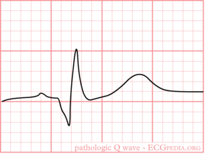 no q wave on ekg