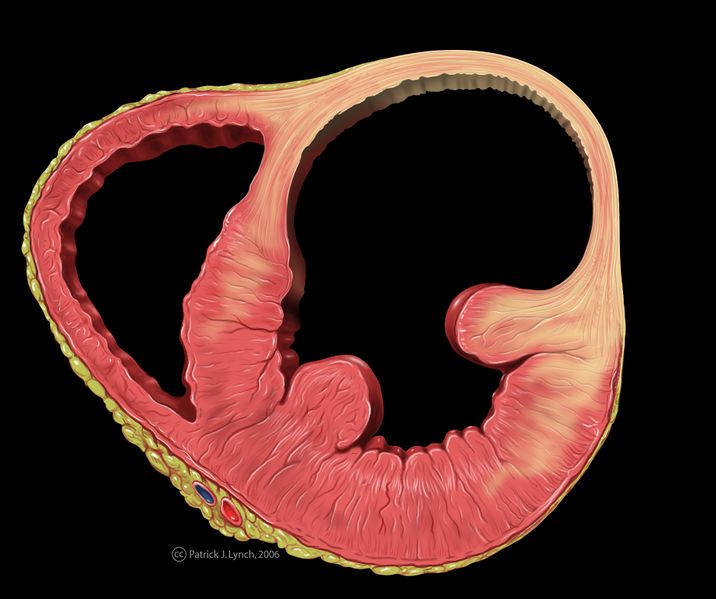Bestand:Heart left ventricular aneurysm sa.jpg