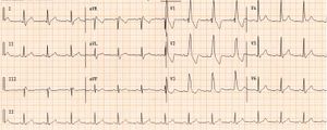 Wide qrs tachy AAM2.jpg