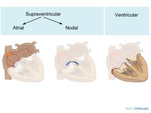 ventricular tachycardia vs supraventricular tachycardia