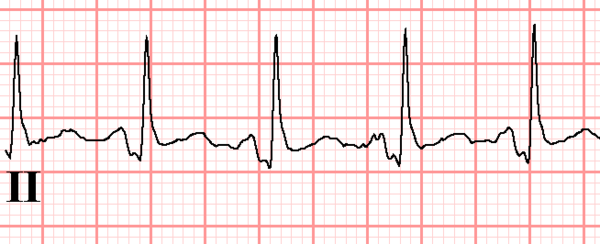 PTa segment - ECGpedia