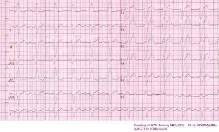 Intraventricular Conduction - ECGpedia